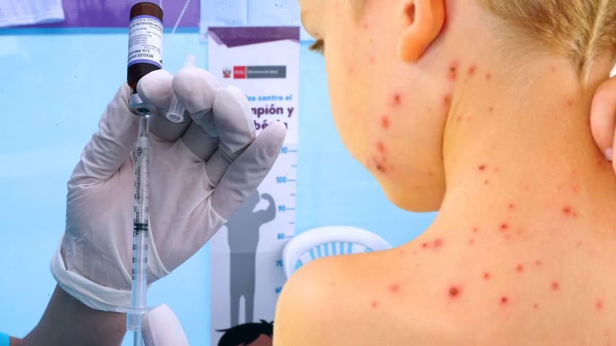 Sarampión en México: Dónde Vacunarse y Por Qué es Crucial