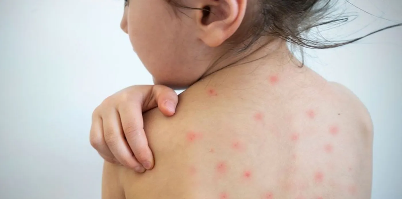Sarampión en Zacatecas: 5 casos en menores disparan alerta sanitaria