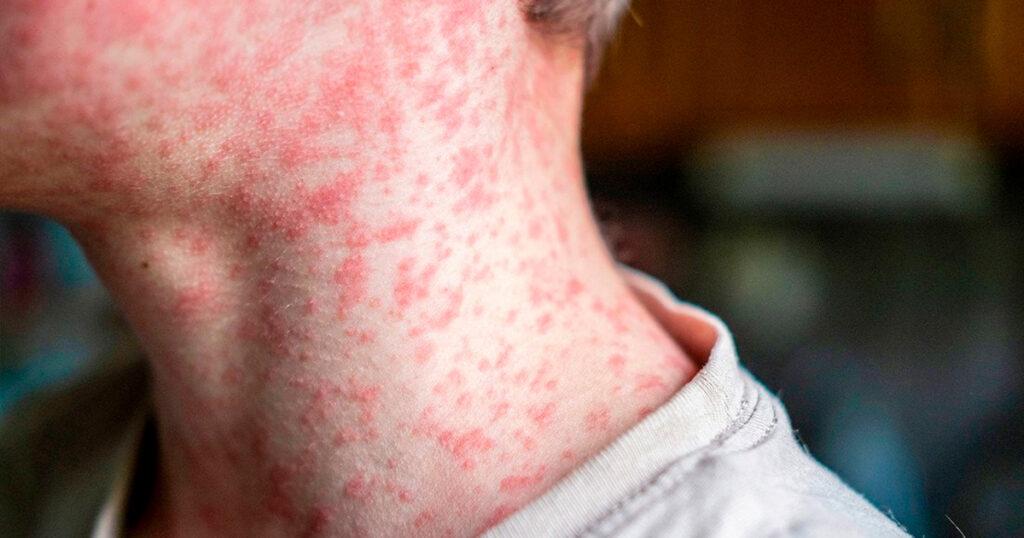 Sarampión en Chihuahua: Brote se dispara con 400 casos y alarma sanitaria