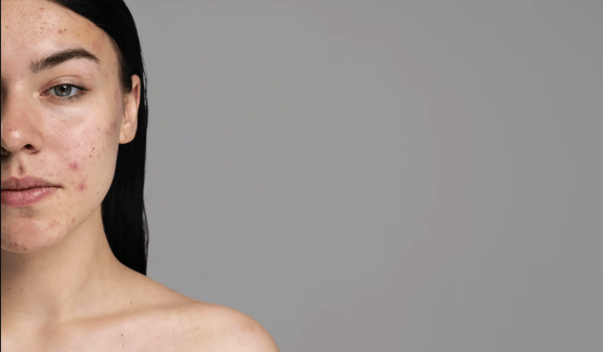 Acné y trastornos alimentarios: la relación oculta que está alarmando a los expertos