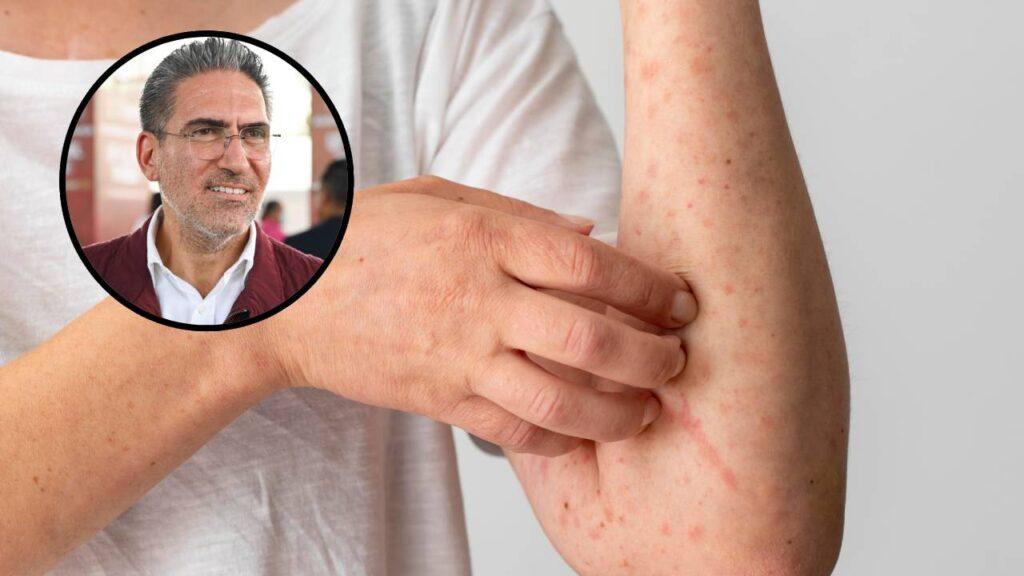 Primer caso de sarampión en Quintana Roo prende las alertas sanitarias