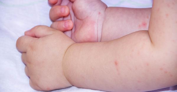 Herpes en bebés