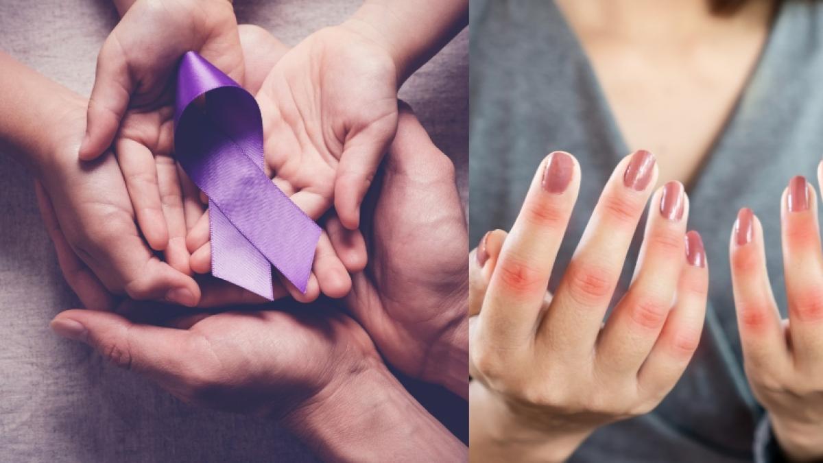 Lupus: La silenciosa amenaza que ataca desde dentro