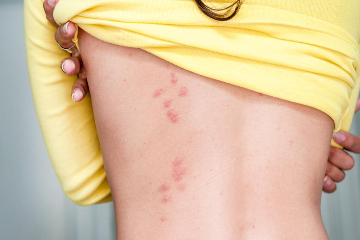 Picaduras de chinches: remedios caseros que realmente alivian