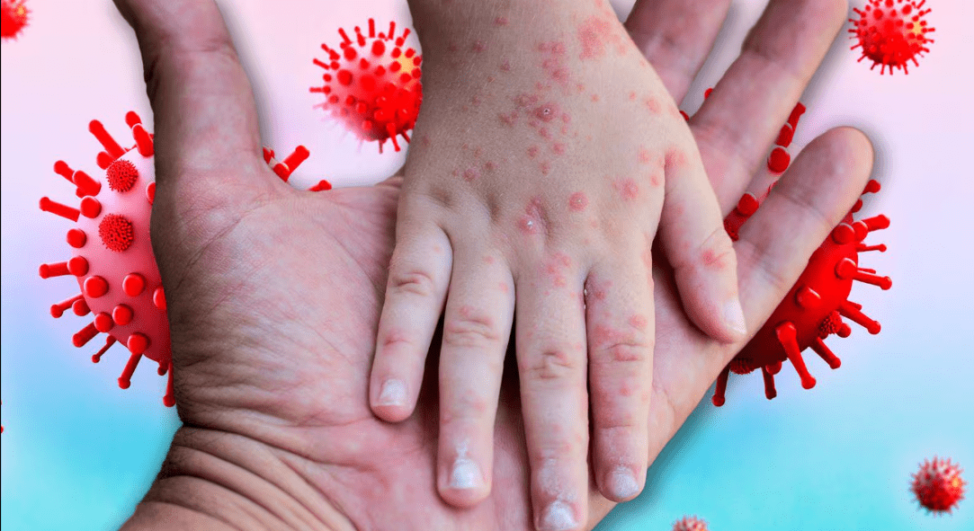 Alerta por sarampión: Niños muertos en México reavivan temores por brotes