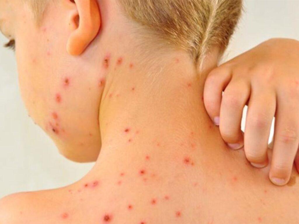 Sarampión infantil: ¿Cuáles son los síntomas y señales de alerta?