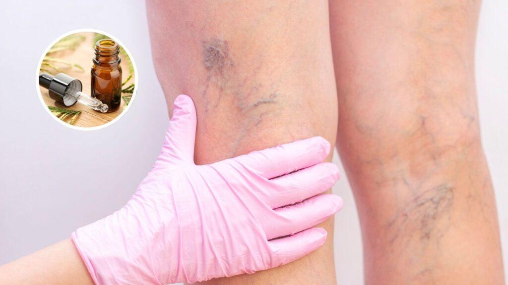 Aceites esenciales para aliviar várices: Guía y usos seguros