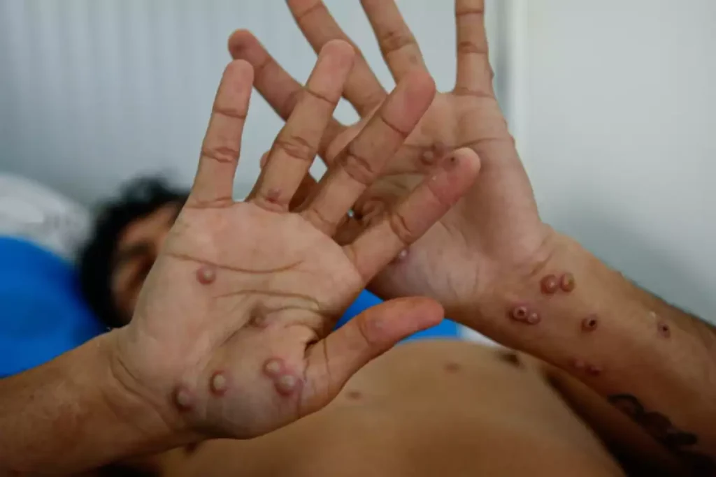 Fallece joven en Cancún por Mpox y graves complicaciones de salud