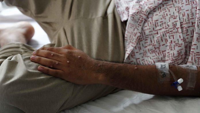 Chiapas confirma caso de mpox en Tuxtla Gutiérrez Chiapas confirma caso de mpox en Tuxtla Gutiérrez