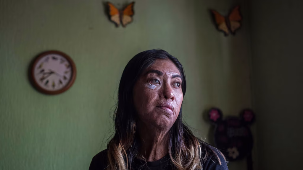 Grave ataque con ácido a menor en San Luis Potosí genera conmoción