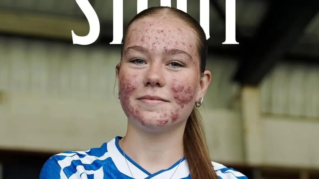 Skye Stout, futbolista de 16 años, víctima de acoso en redes por su acné