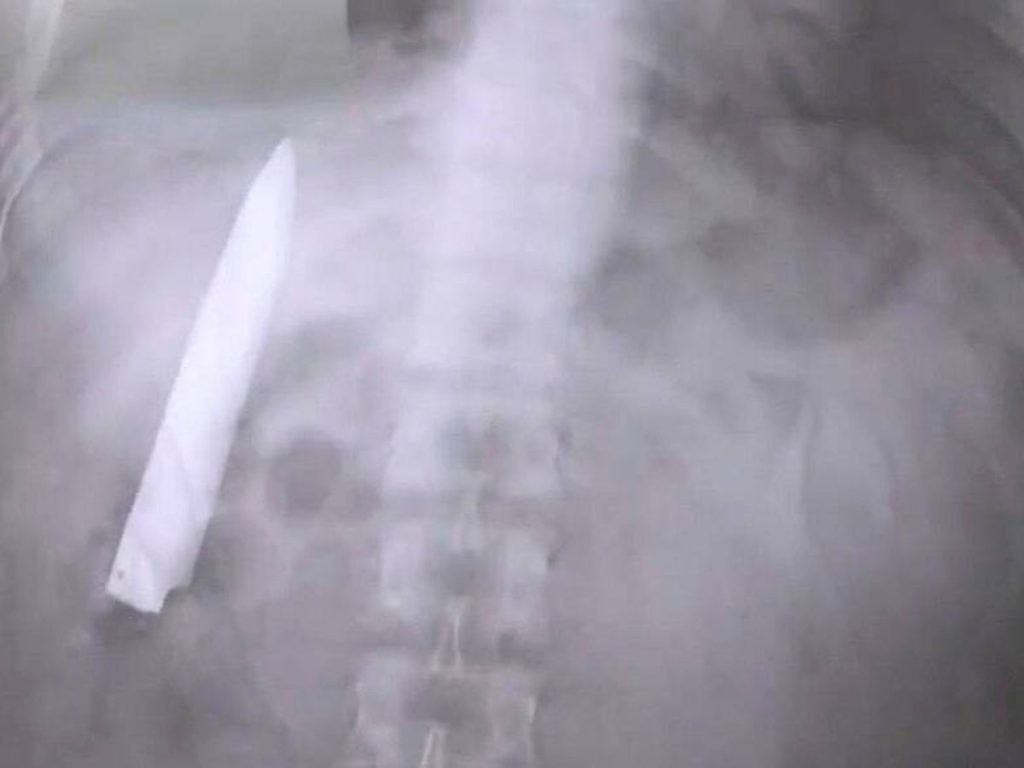 Sorprendente hallazgo: Hombre vivió una década con un cuchillo en el pecho