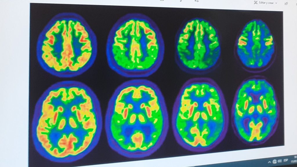 Ultrasonido: Nueva esperanza contra Alzheimer y cáncer