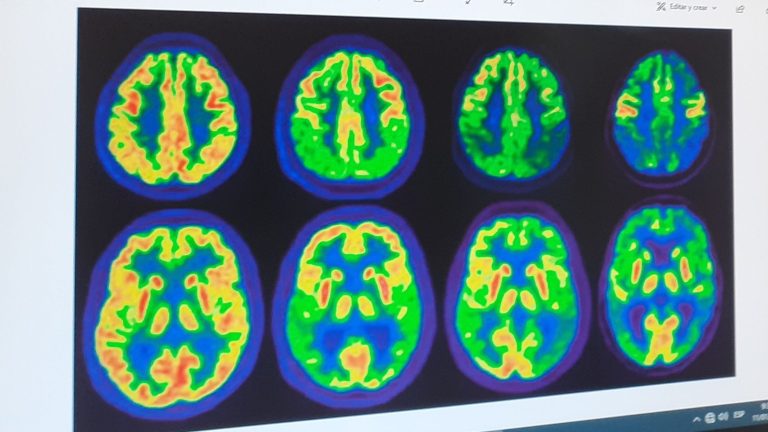 Ultrasonido: Nueva esperanza contra Alzheimer y cáncer