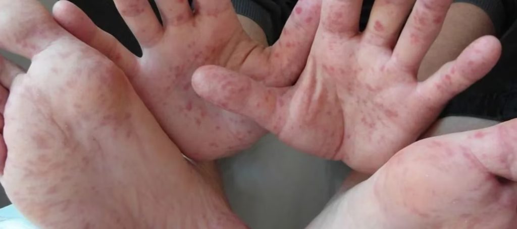 Virus Coxsackie: Aumentan a 231 los casos en Baja California