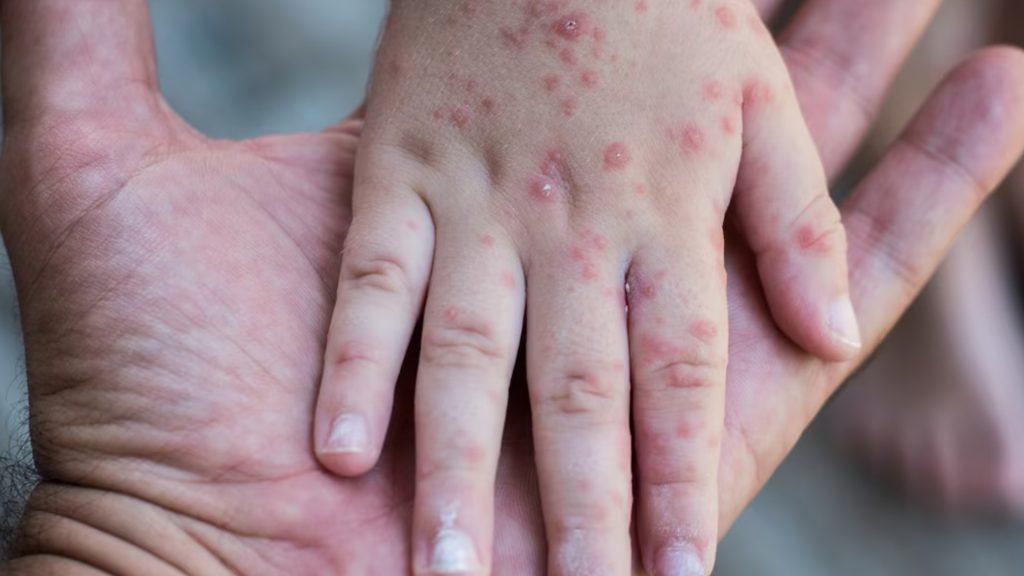 Alerta sanitaria en Chihuahua: 70 brotes del virus Coxsackie en escuelas