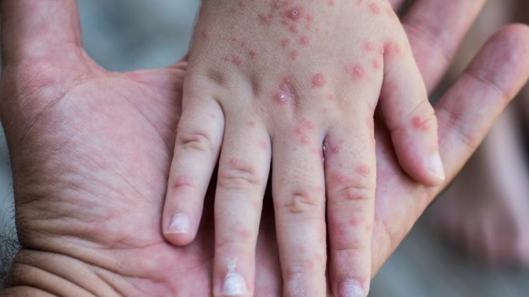 Alerta sanitaria en Chihuahua: 70 brotes del virus Coxsackie en escuelas