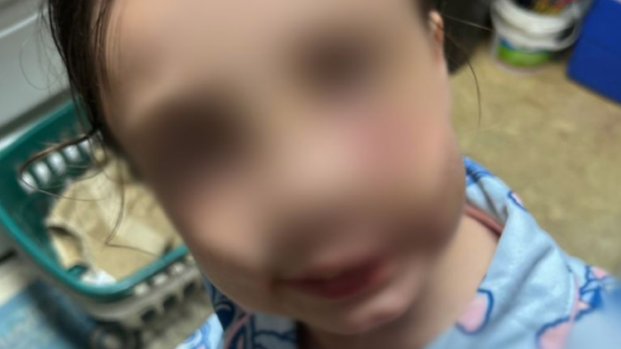Ataque brutal de un pastor australiano azul a niña de 9 años en Alabama Ataque brutal de un pastor australiano azul a niña de 9 años en Alabama