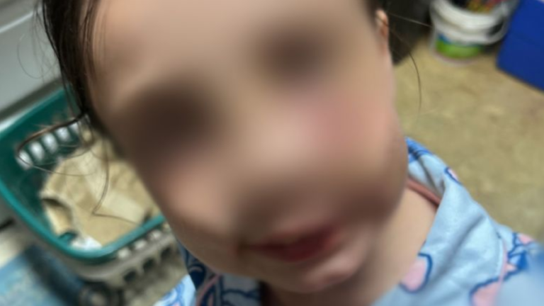 Ataque brutal de un pastor australiano azul a niña de 9 años en Alabama