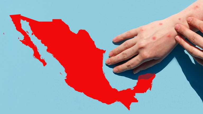 México en alerta máxima por sarampión: 5,580 casos en 29 estados